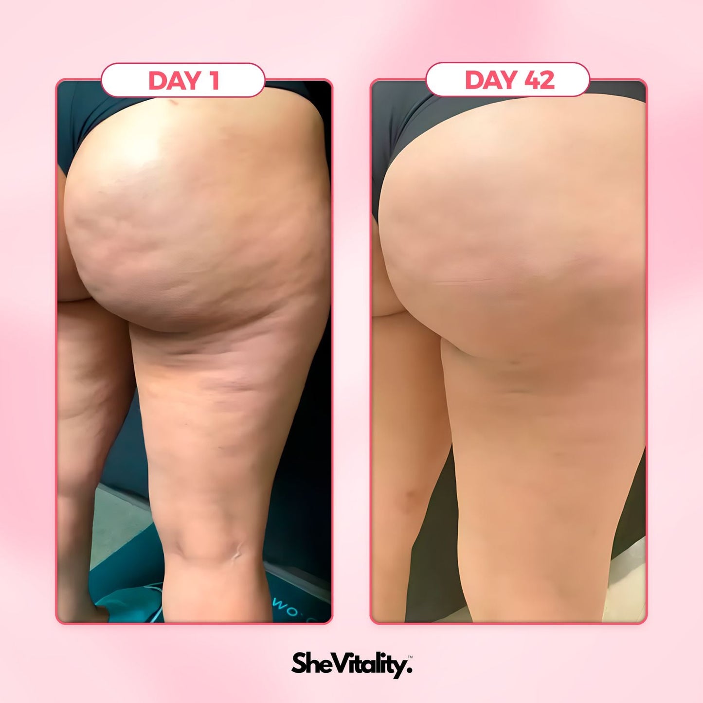 Smooth Skin Cellulite Kit