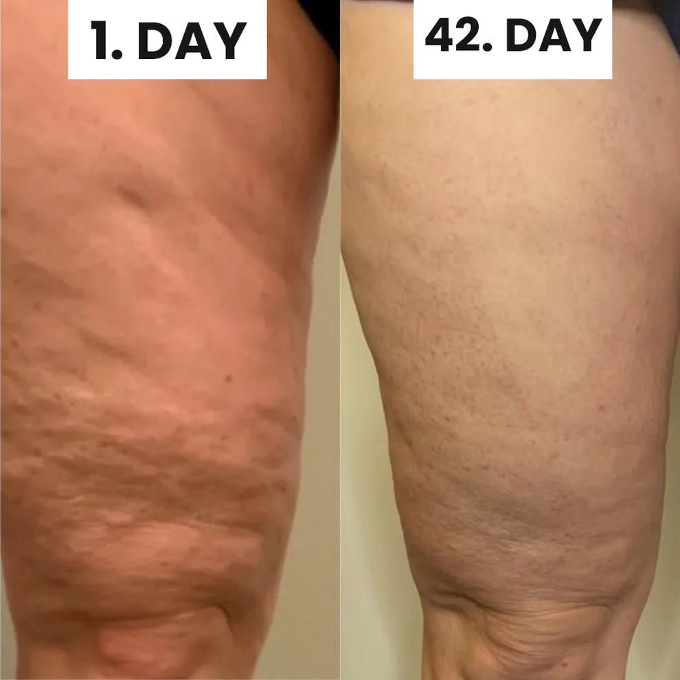 Smooth Skin Cellulite Kit